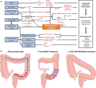 Variable Gut Function Recovery After Right vs. Left Colectomy May Be Due to Rectosigmoid Hyperactivity